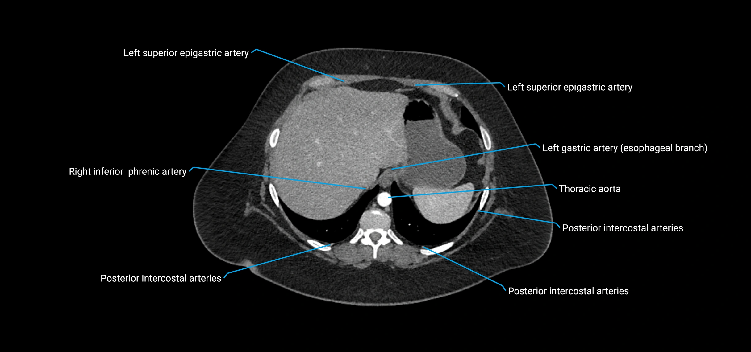 CTA abdomen axial cross sectional anatomy labelled image_26 (3).webp